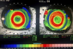 lentes-orto-k-clinica-signes